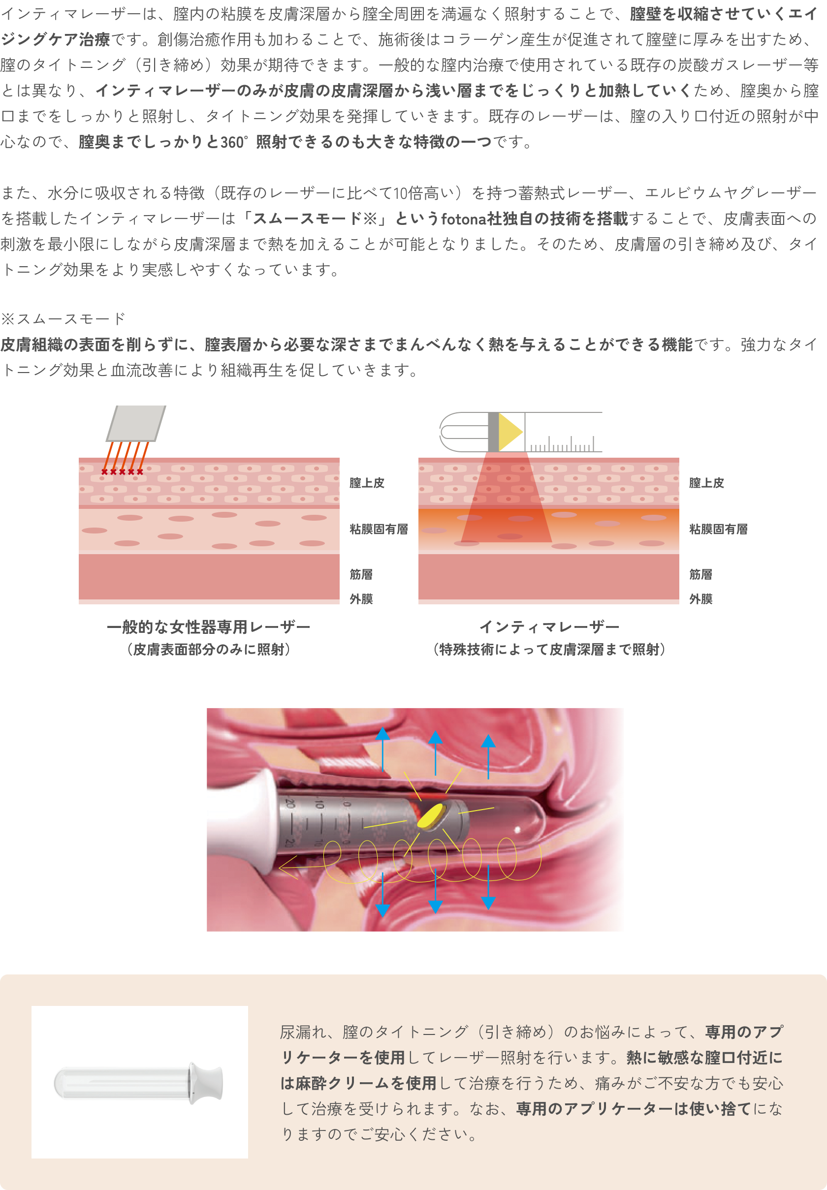 インティマレーザー（尿漏れ・膣のスキンケア）の特徴 