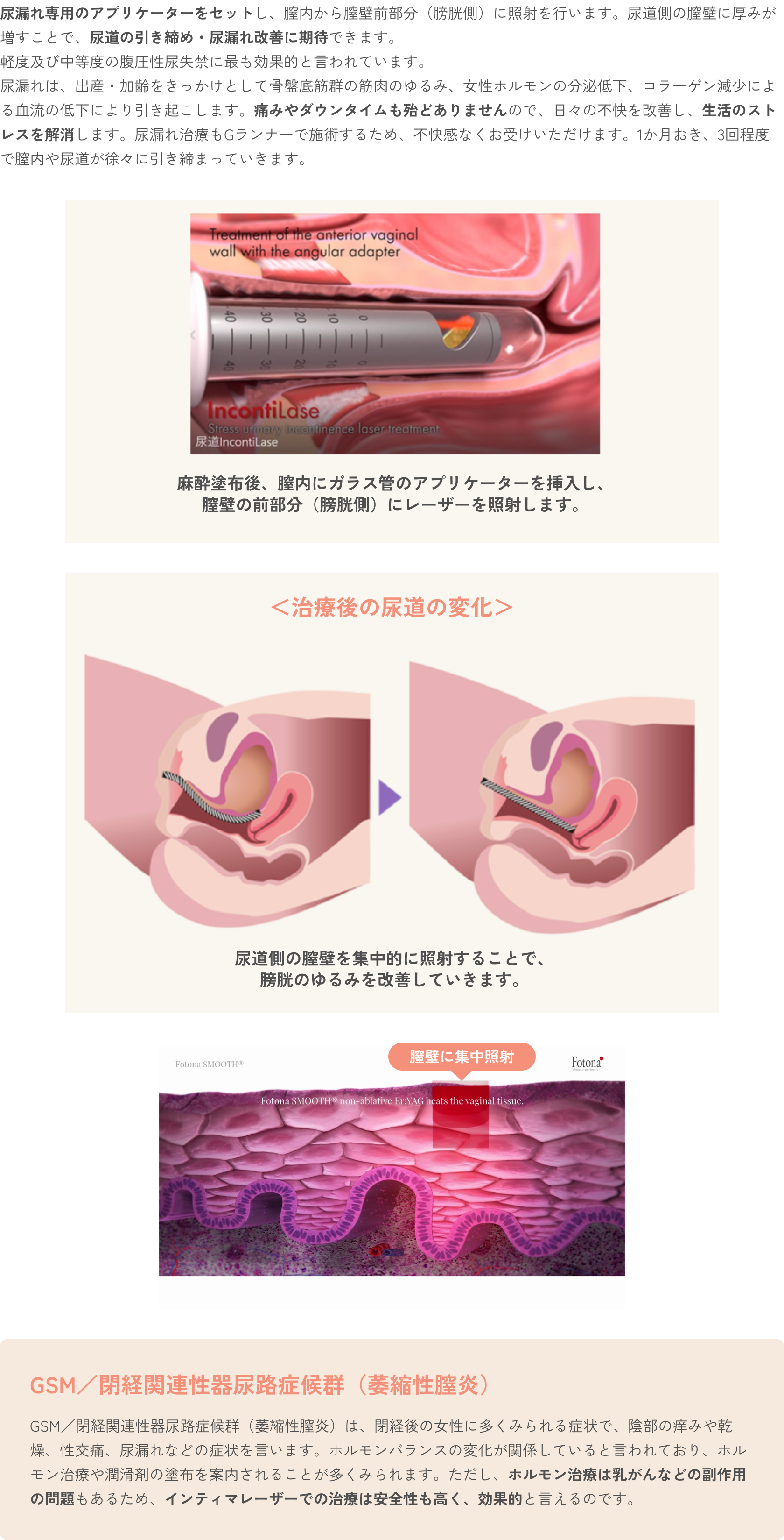 イ尿漏れ治療（Uタイトニング）