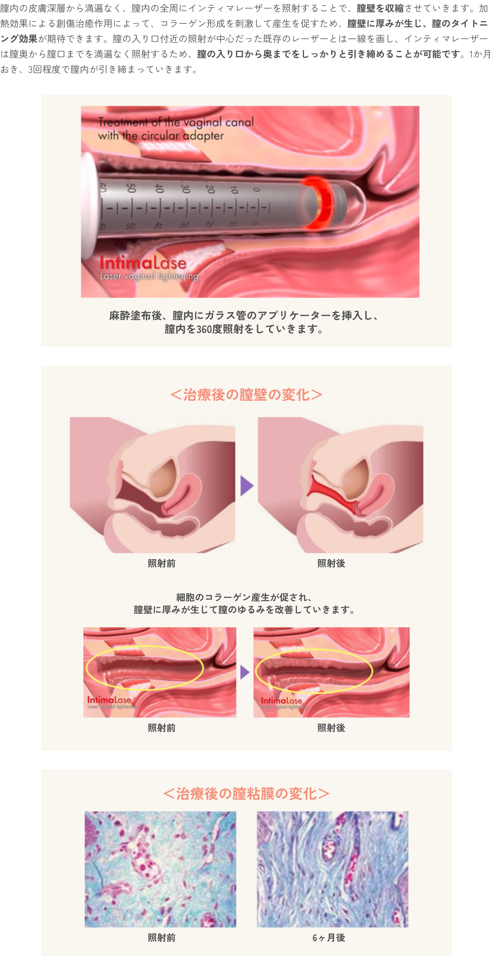 膣の引き締め治療（Vタイトニング）