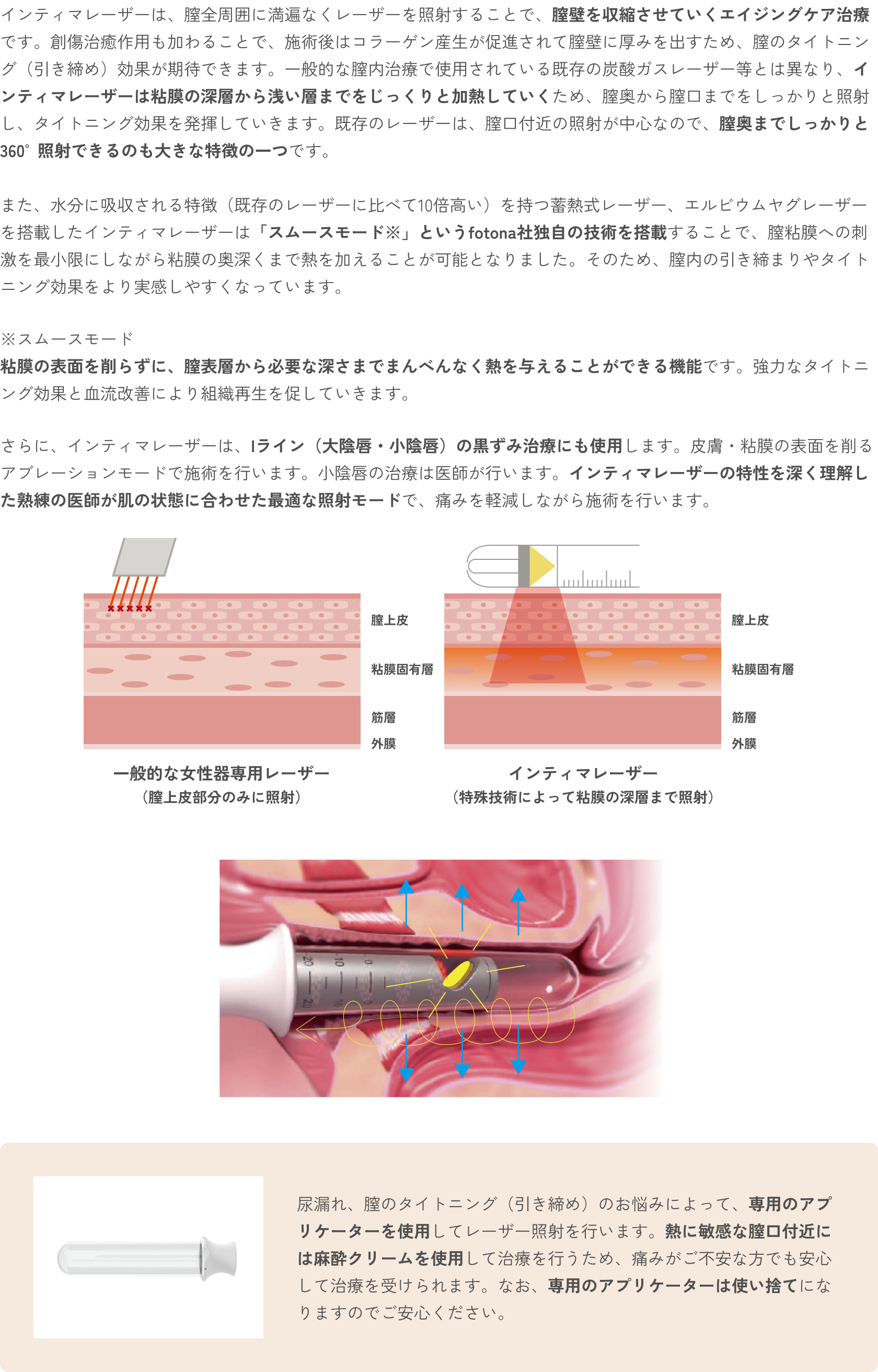 インティマレーザー（尿漏れ・膣のスキンケア）の特徴 