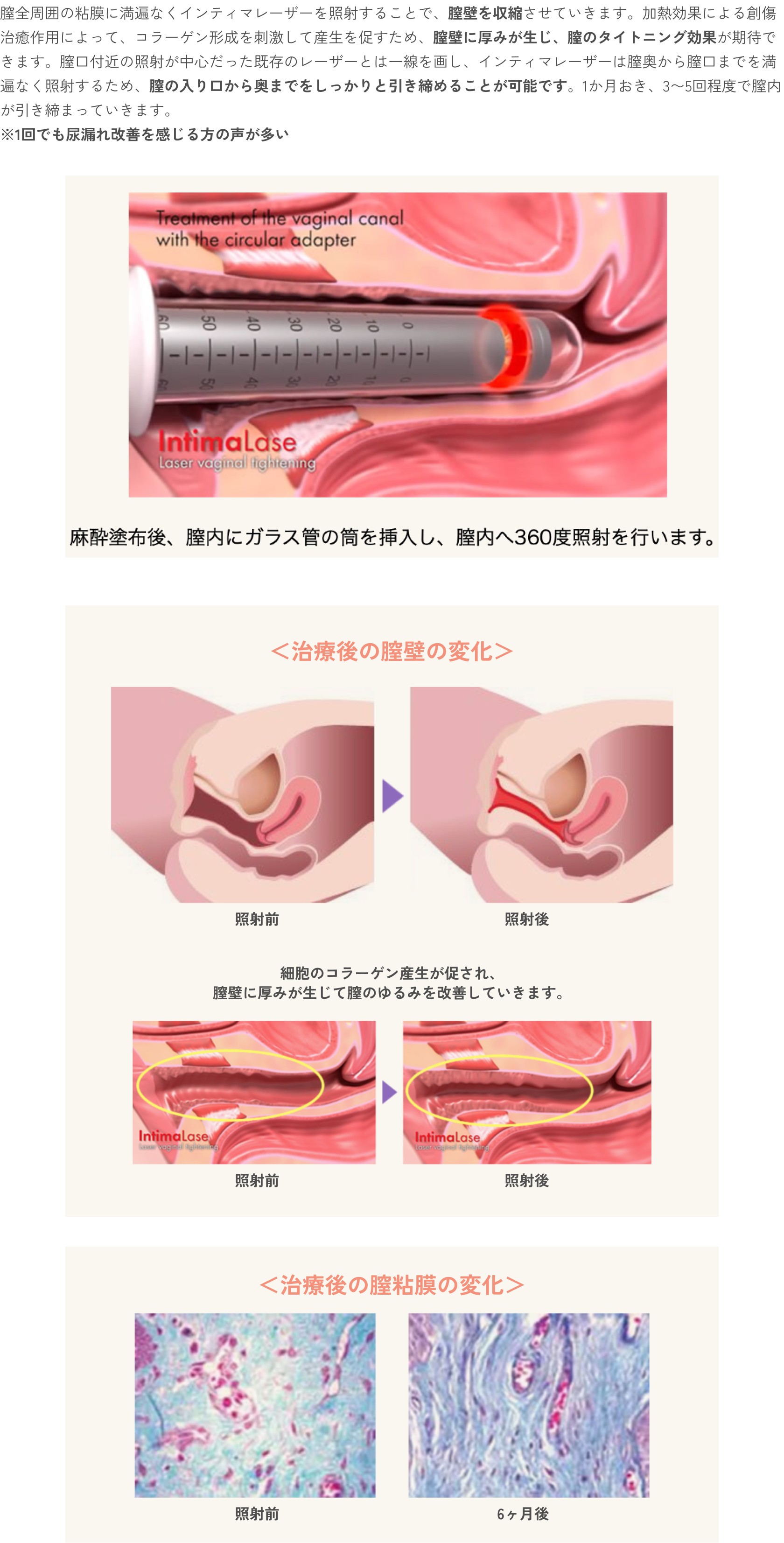 膣の引き締め治療（Vタイトニング）