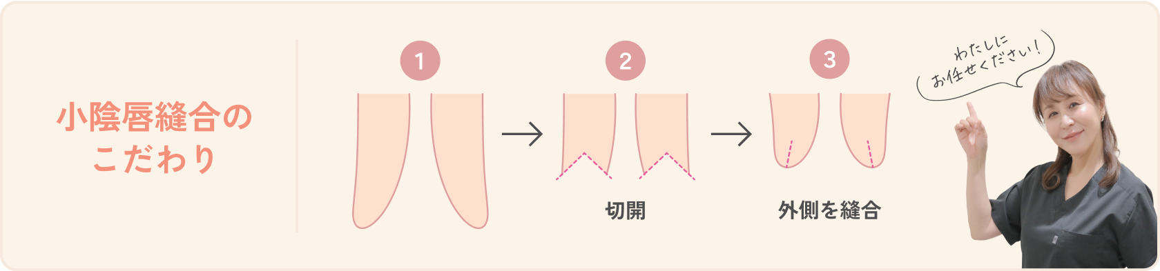 小陰唇縫合のこだわり