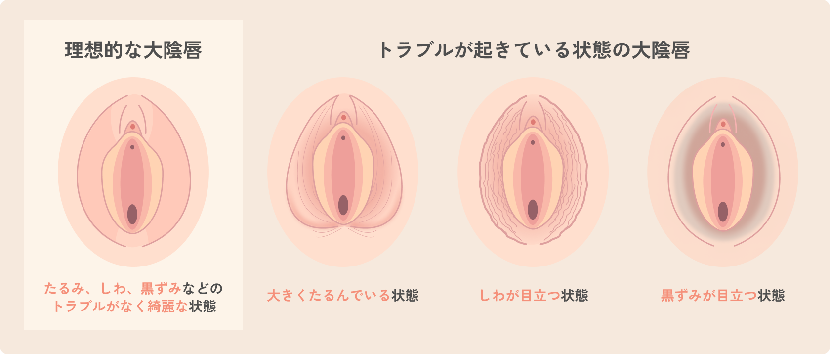 理想的な大陰唇とトラブルが起きている状態の大陰唇