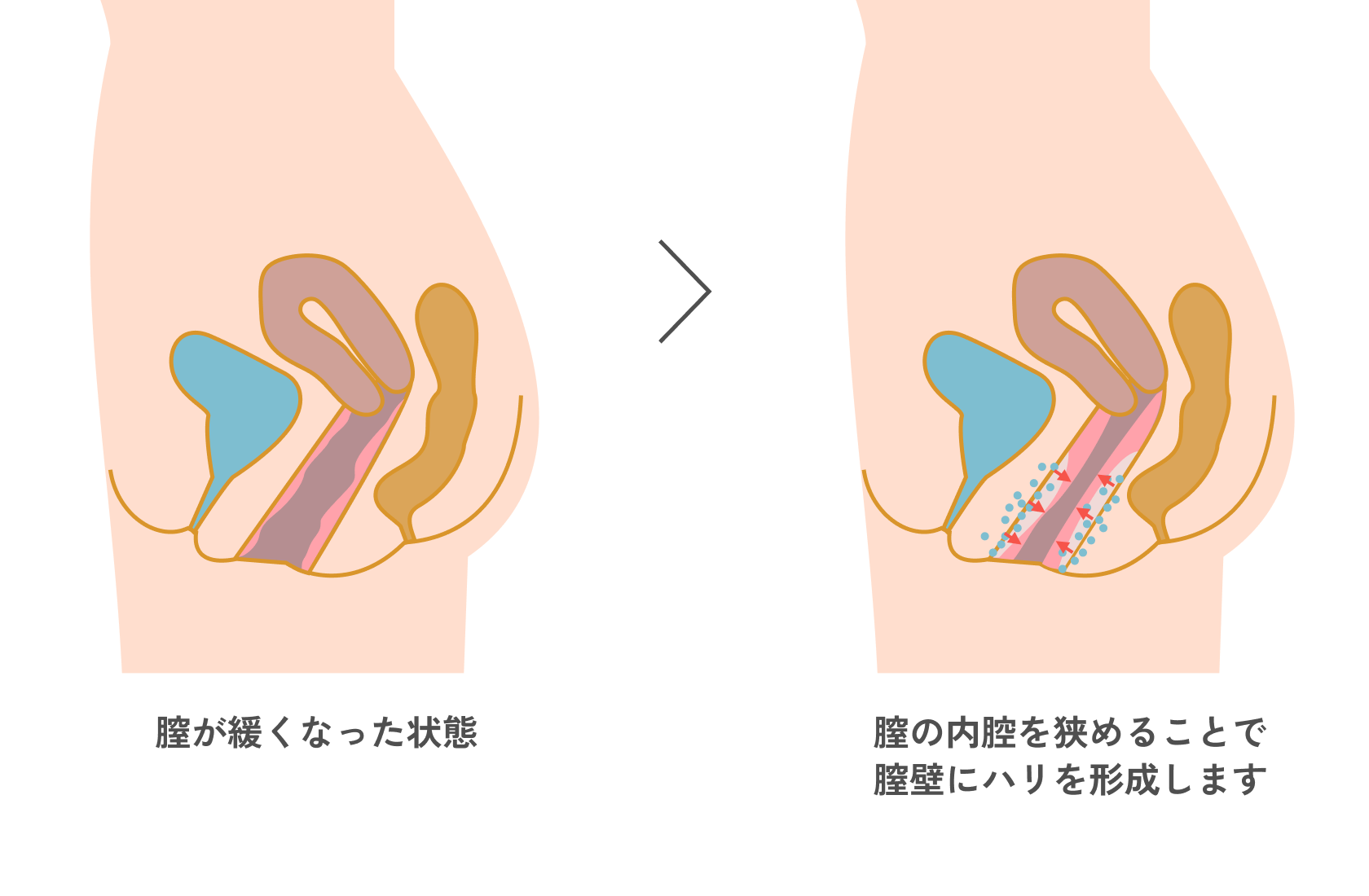 膣の内腔を狭めることで膣壁にハリを形成