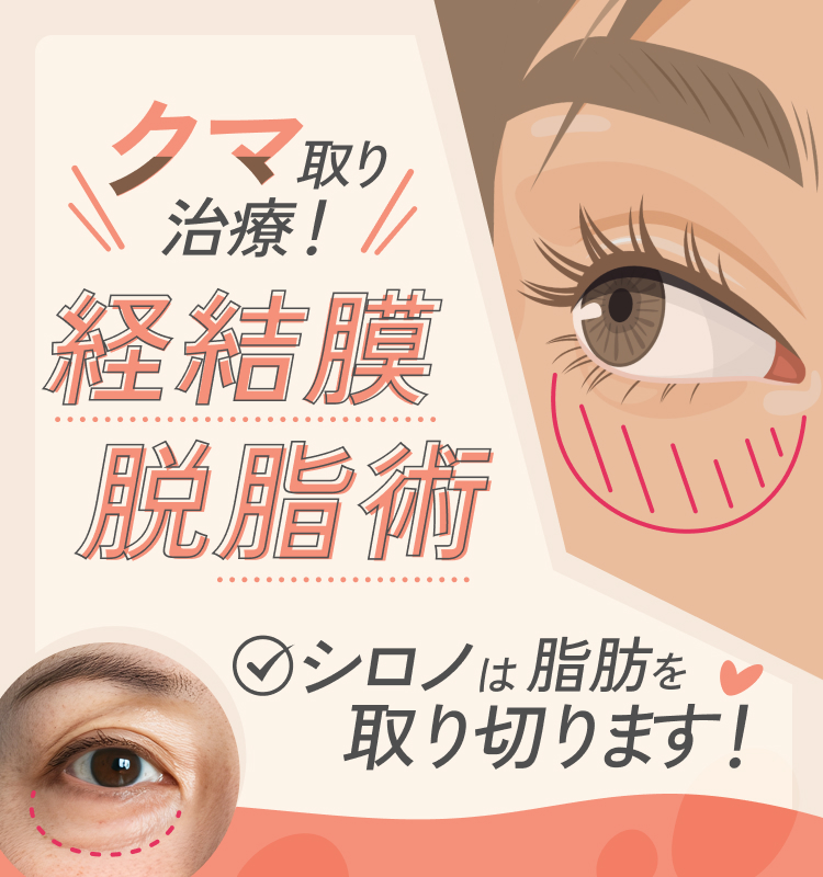 目のたるみ・クマ取り治療（目の下のふくらみ取り）