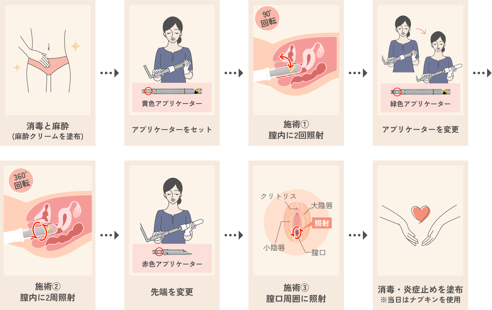 Uタイトニング（尿漏れ）の流れ
