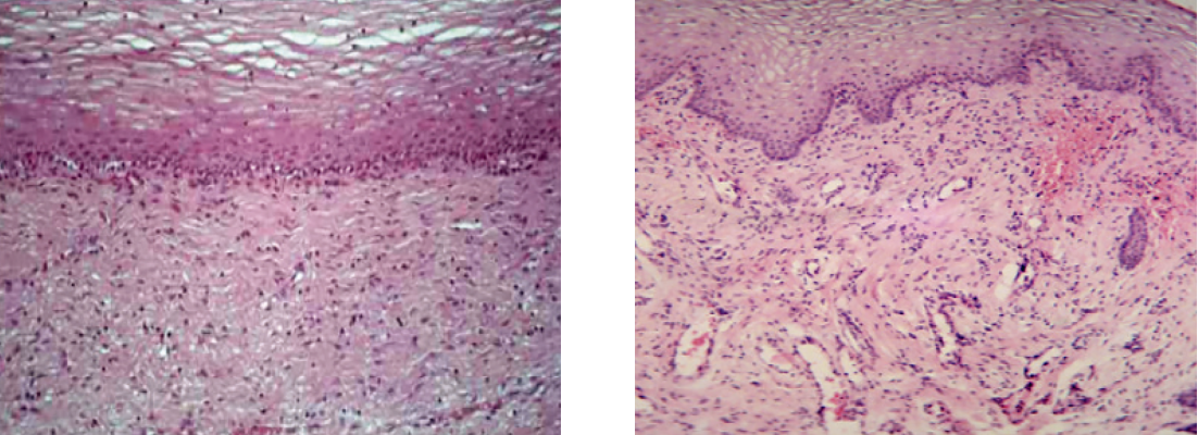 治療後の膣粘膜の変化