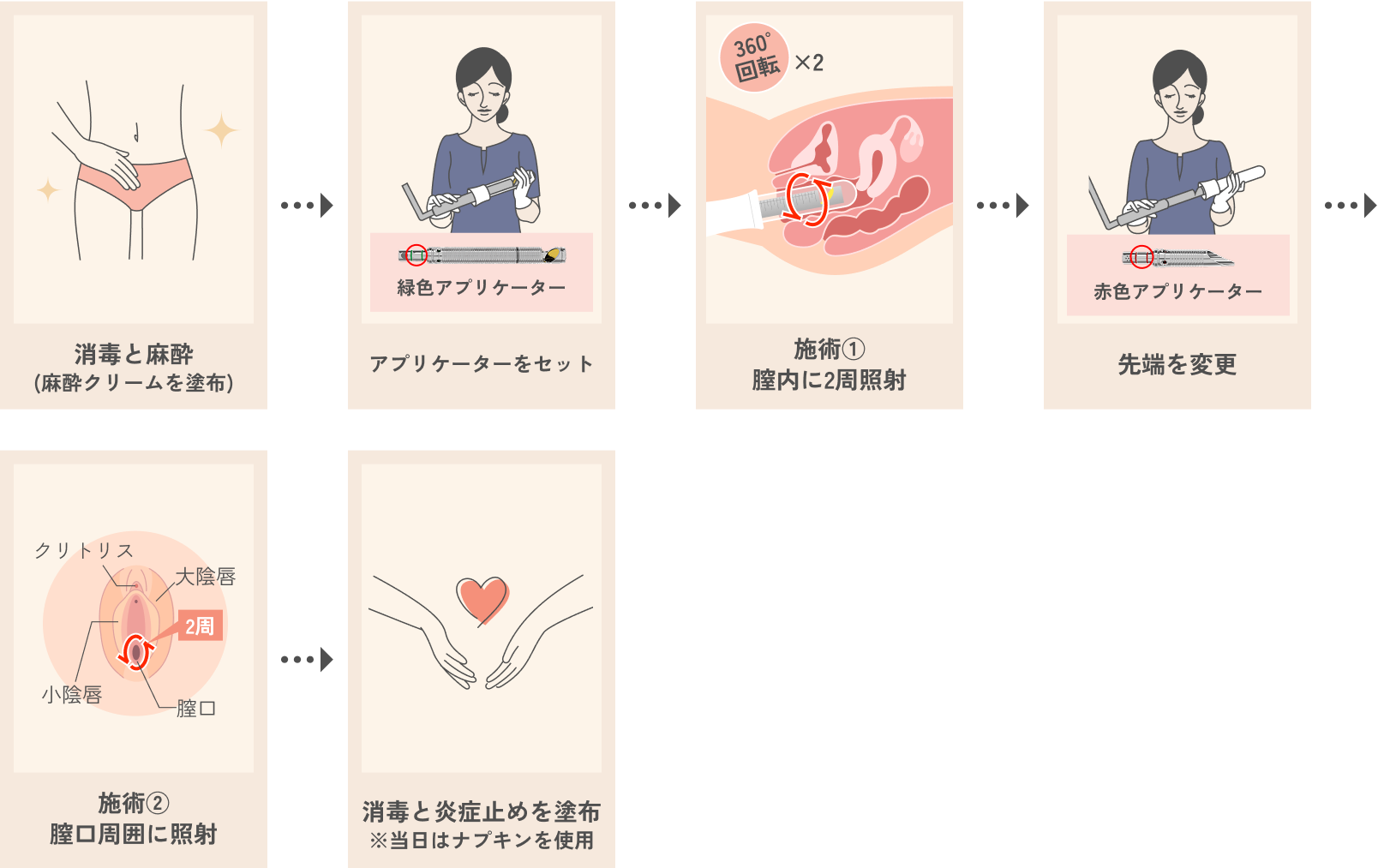 Vタイトニング（膣の引き締め）の流れ