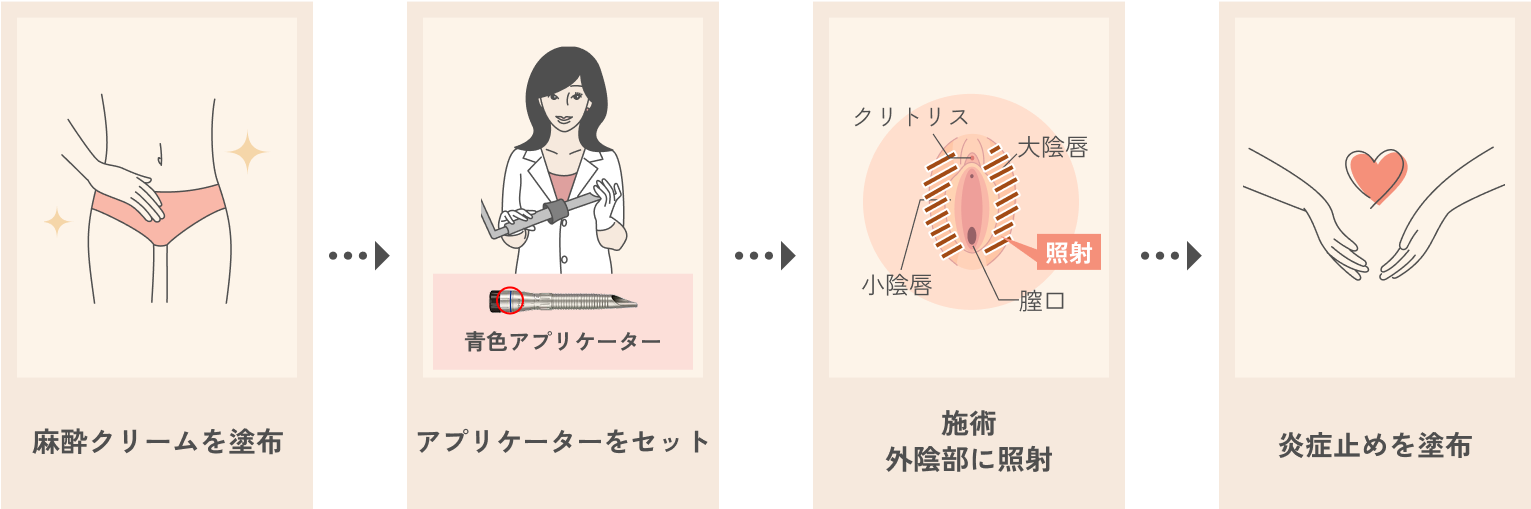 医師施術　Vホワイトニング（外陰部の黒ずみ治療）の流れ