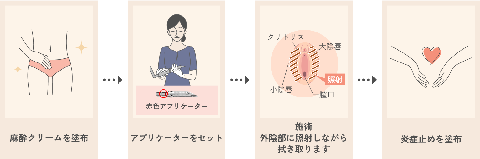 Vホワイトニング（外陰部の黒ずみ治療）の流れ