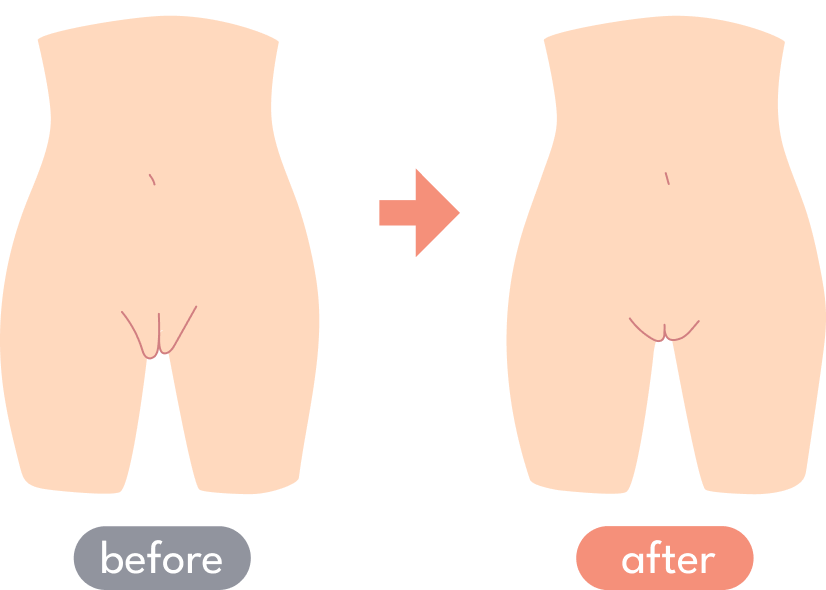 大陰唇縫合のbeforeとafter