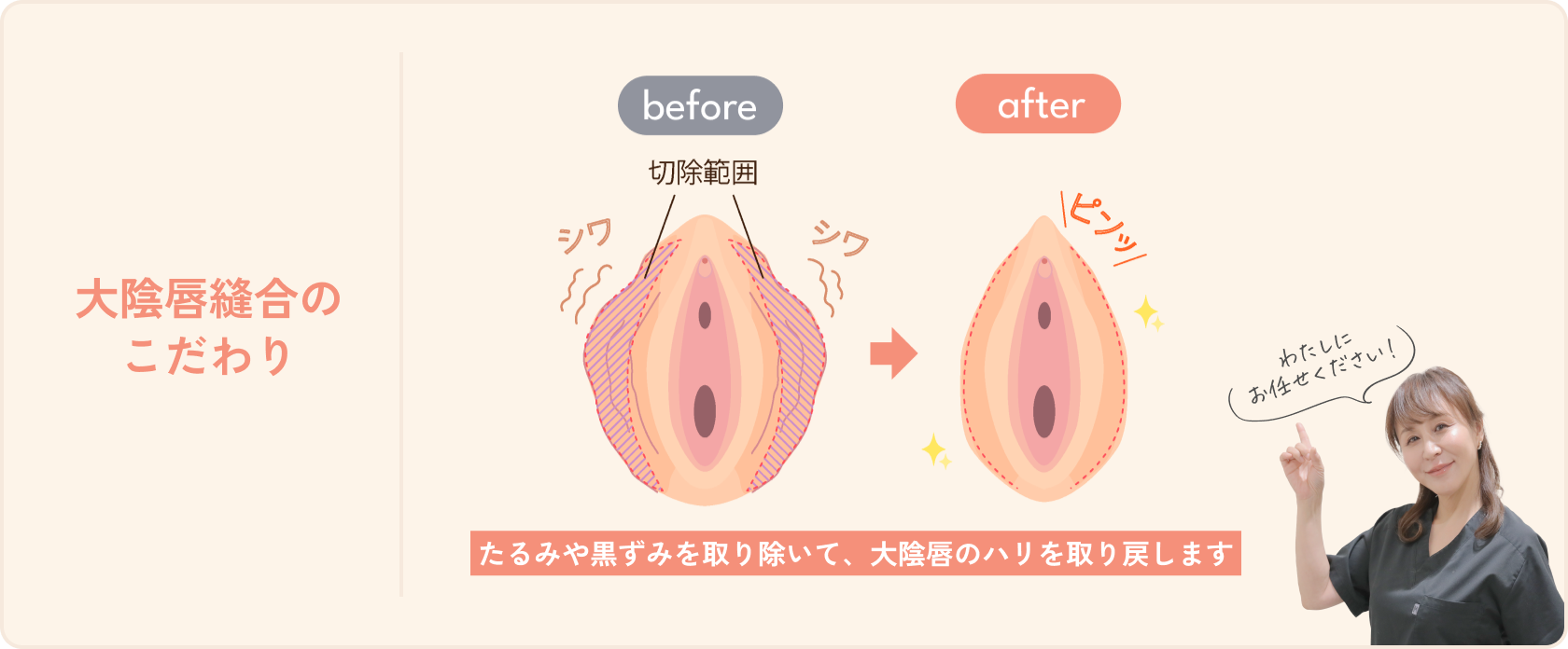 大陰唇縫合のこだわり